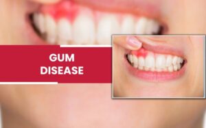Gum