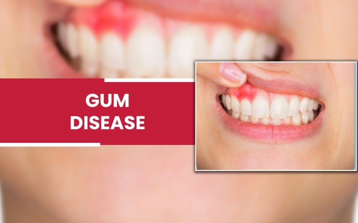 Gum